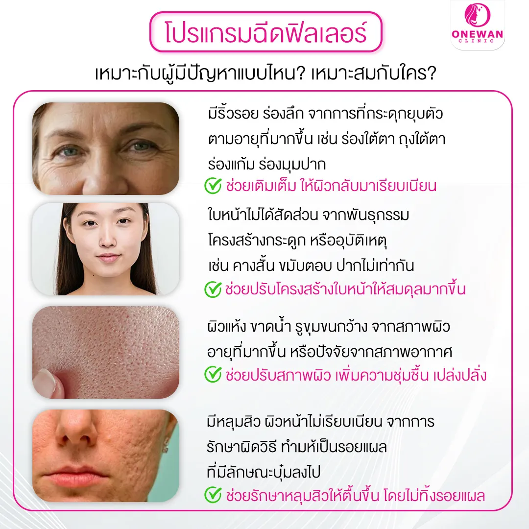 ฟิลเลอร์หน้าแก้มเหมาะกับใคร