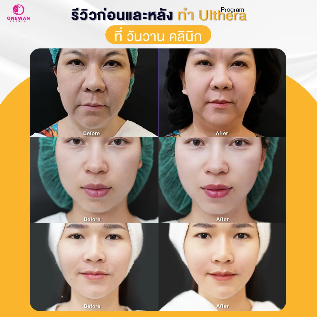 รีวิวก่อนหลังทำ Ulthera Prime