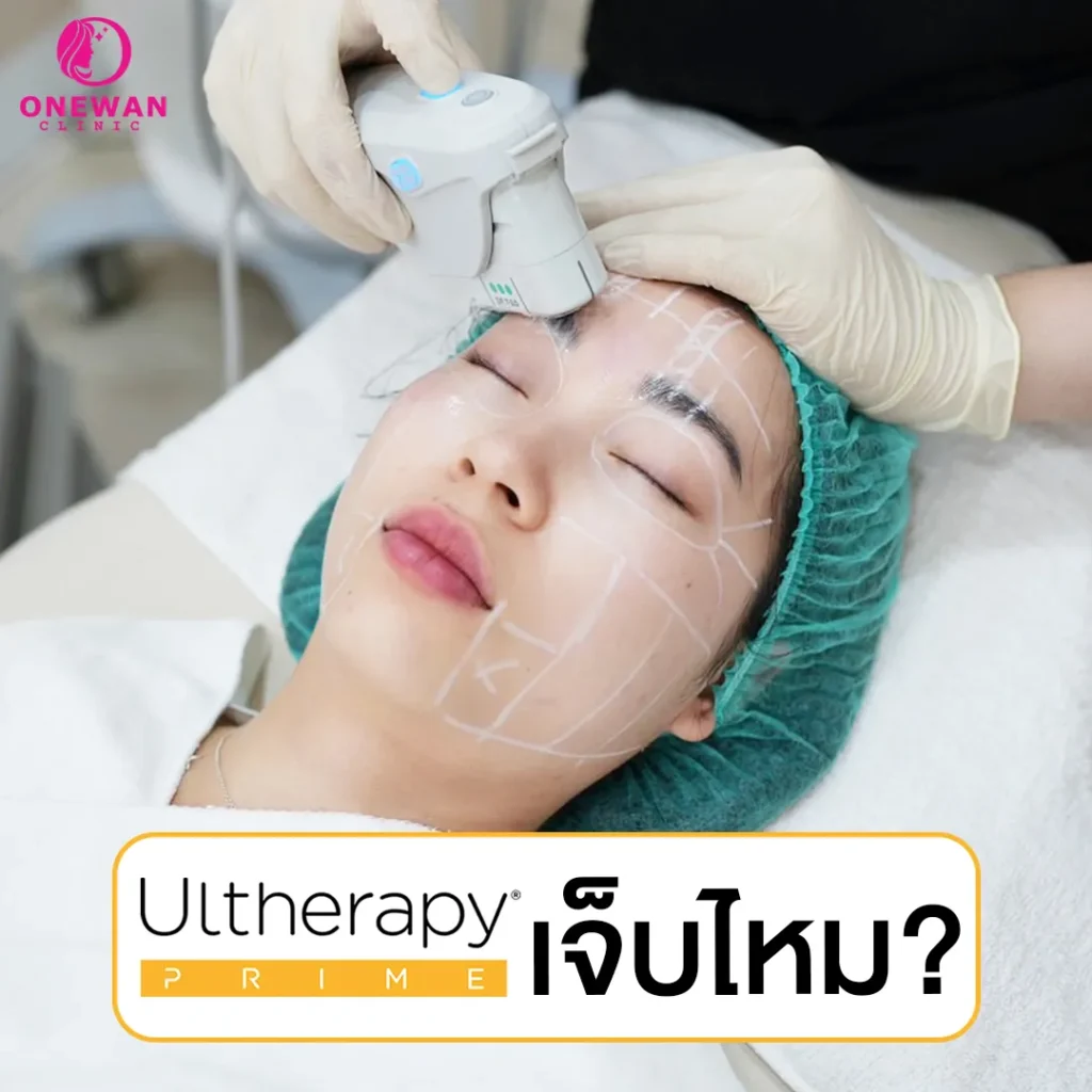 Ulthera Prime เจ็บไหม