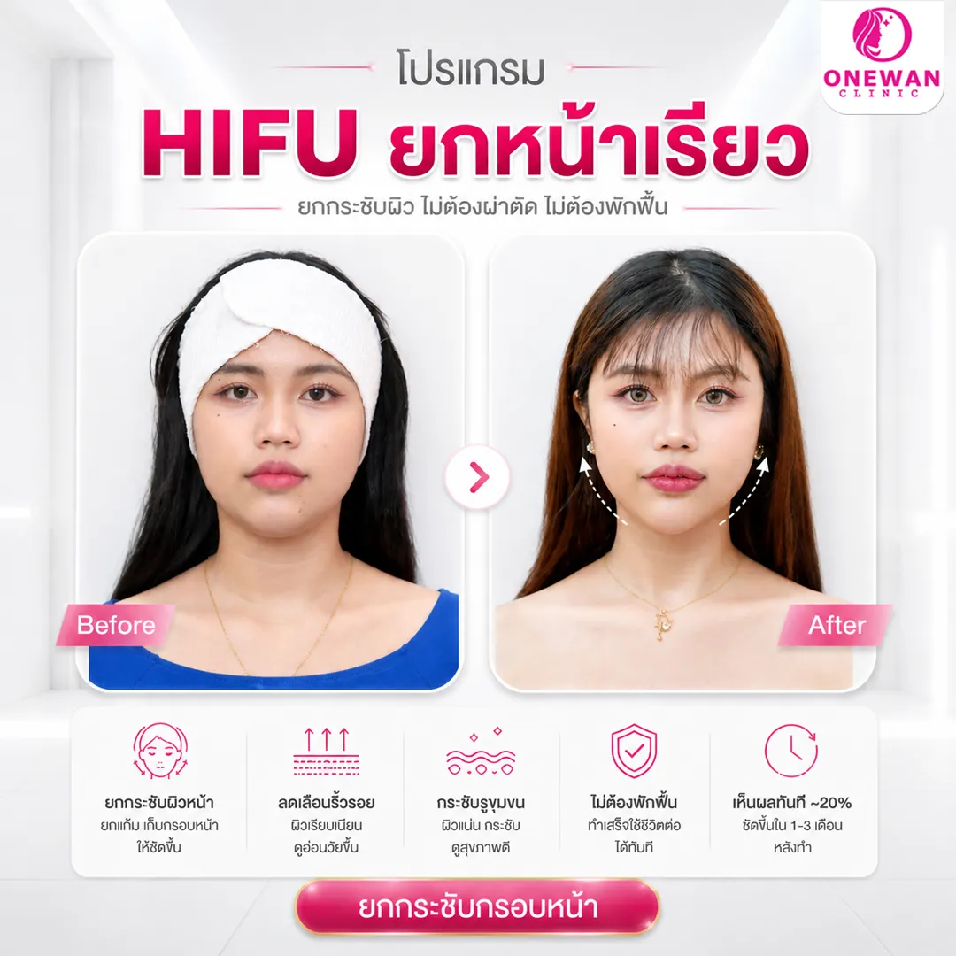 Hifu ยกหน้าเรียว