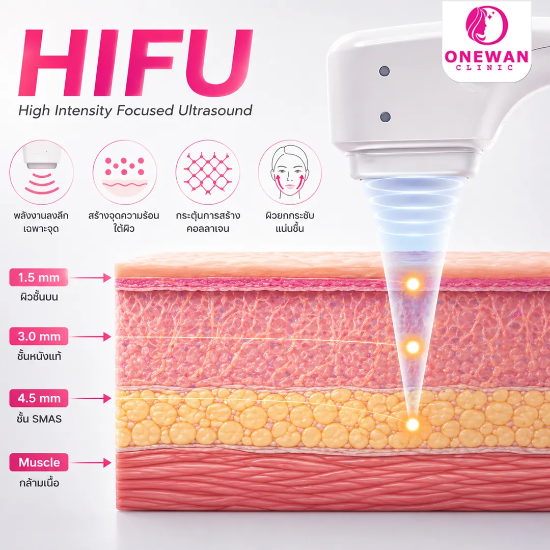 หลักการทำงานของ Hifu