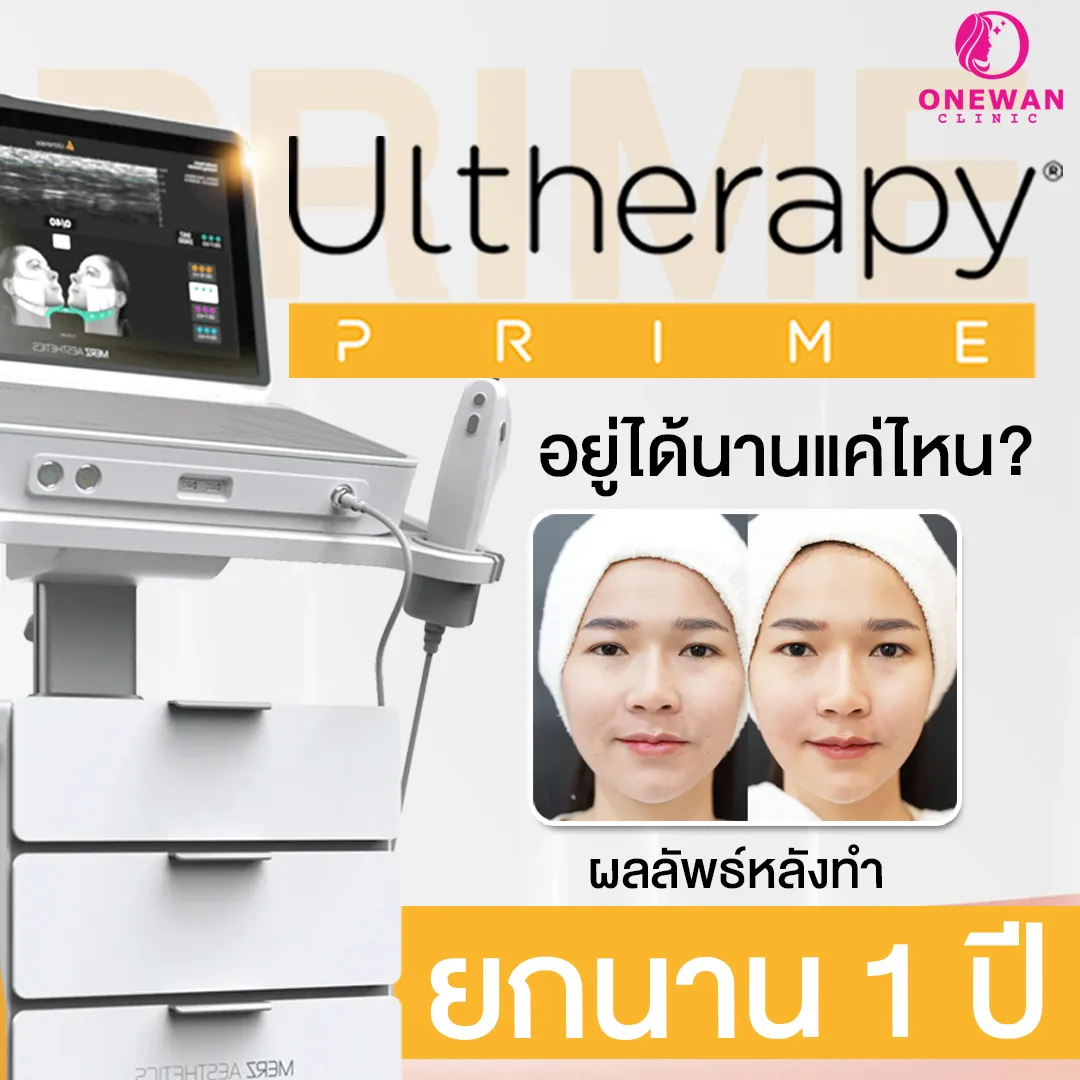 Ulthera Prime อยู่ได้นานแค่ไหน
