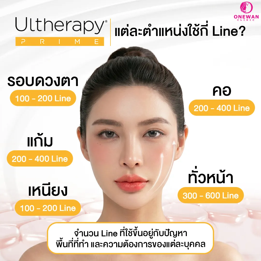 Ulthera Prime แต่ละตำแหน่งใช้กี่ Shots (Lines)