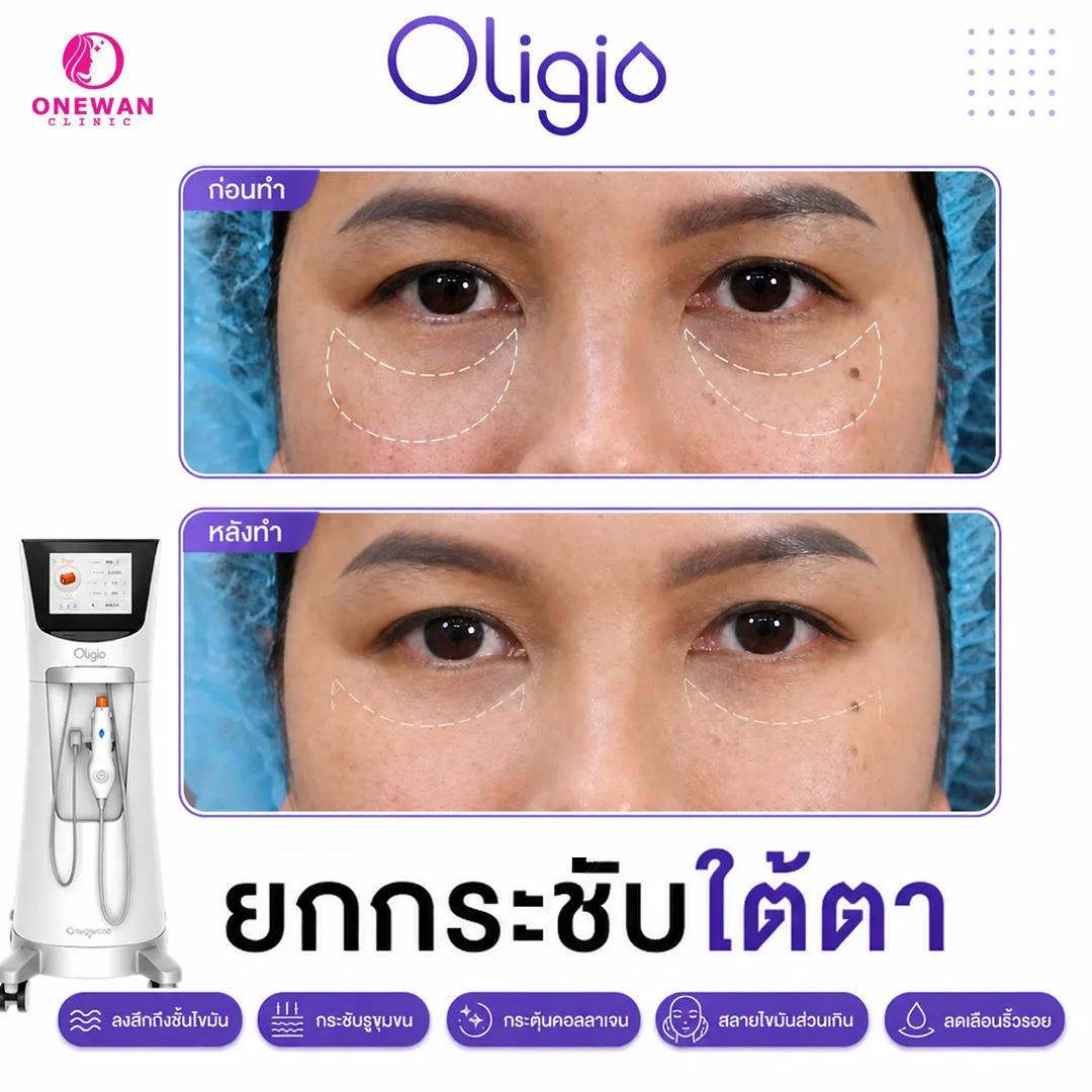 Oligio ยกกระชับใต้ตา