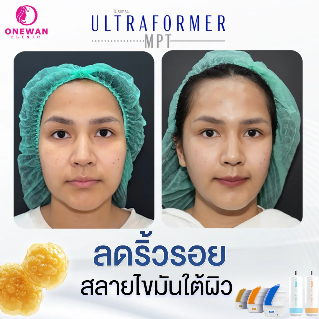 ลดริ้วรอย สลายไขมันใต้ผิว