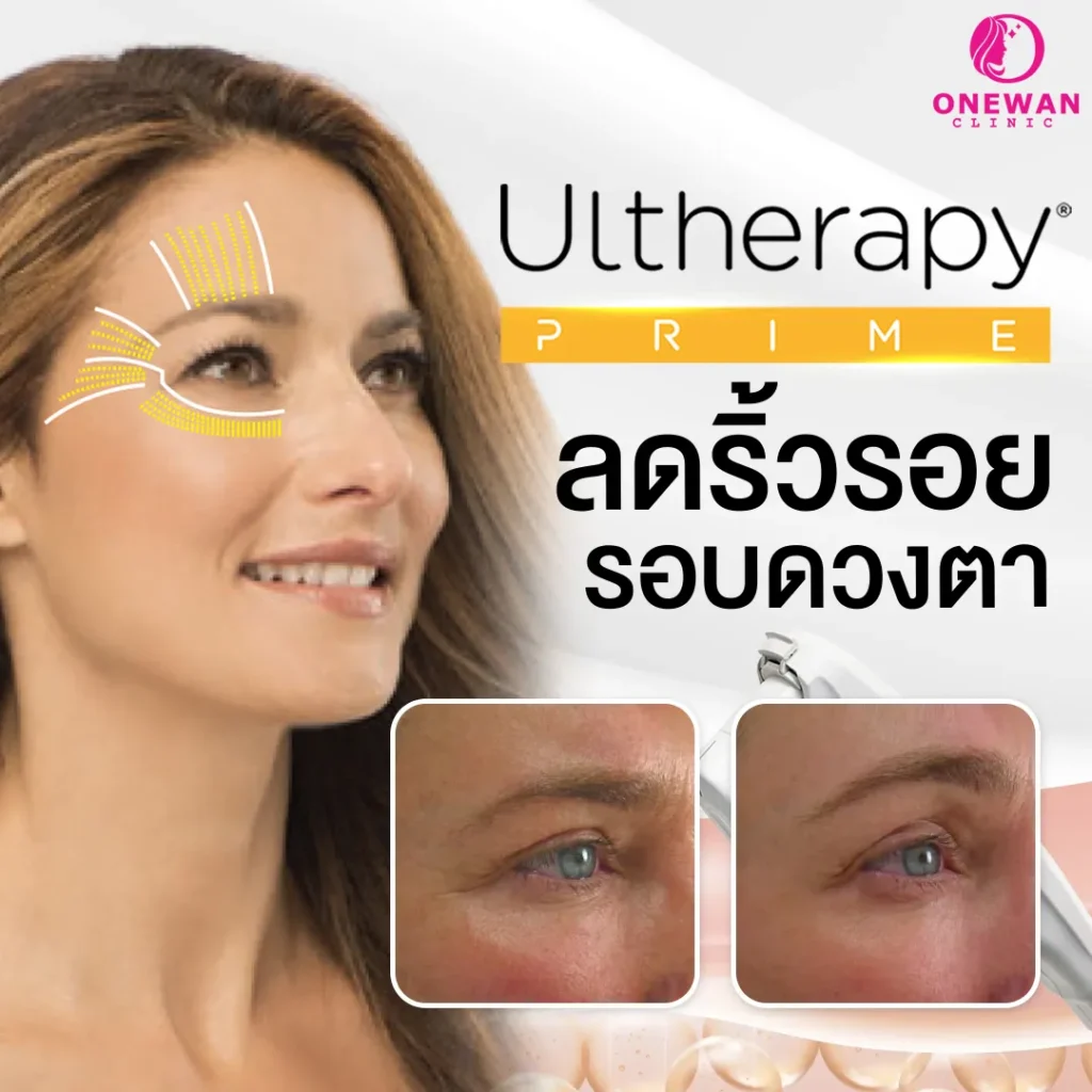 ลดริ้วรอยรอบตา Ulthera Prime
