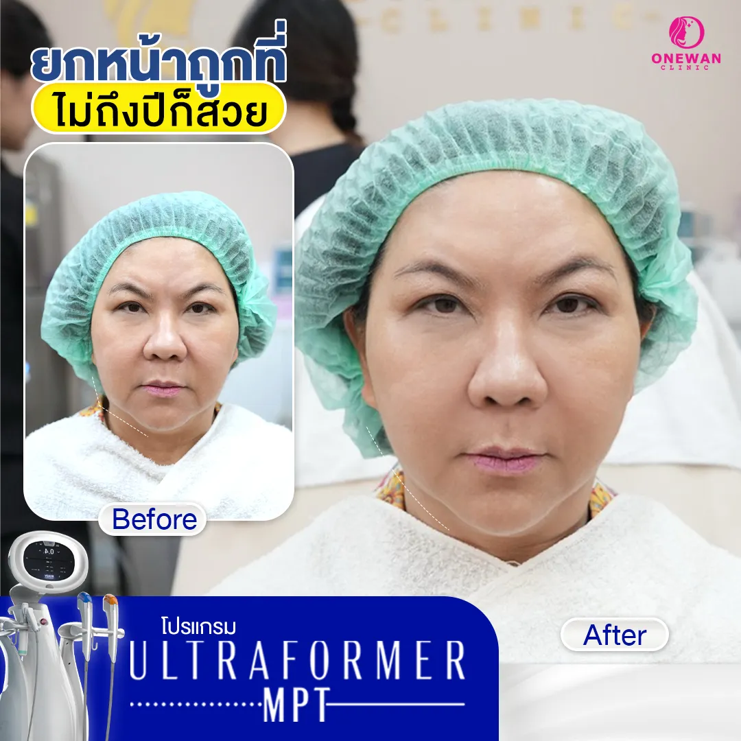 Review 1 Ultraformer MPT