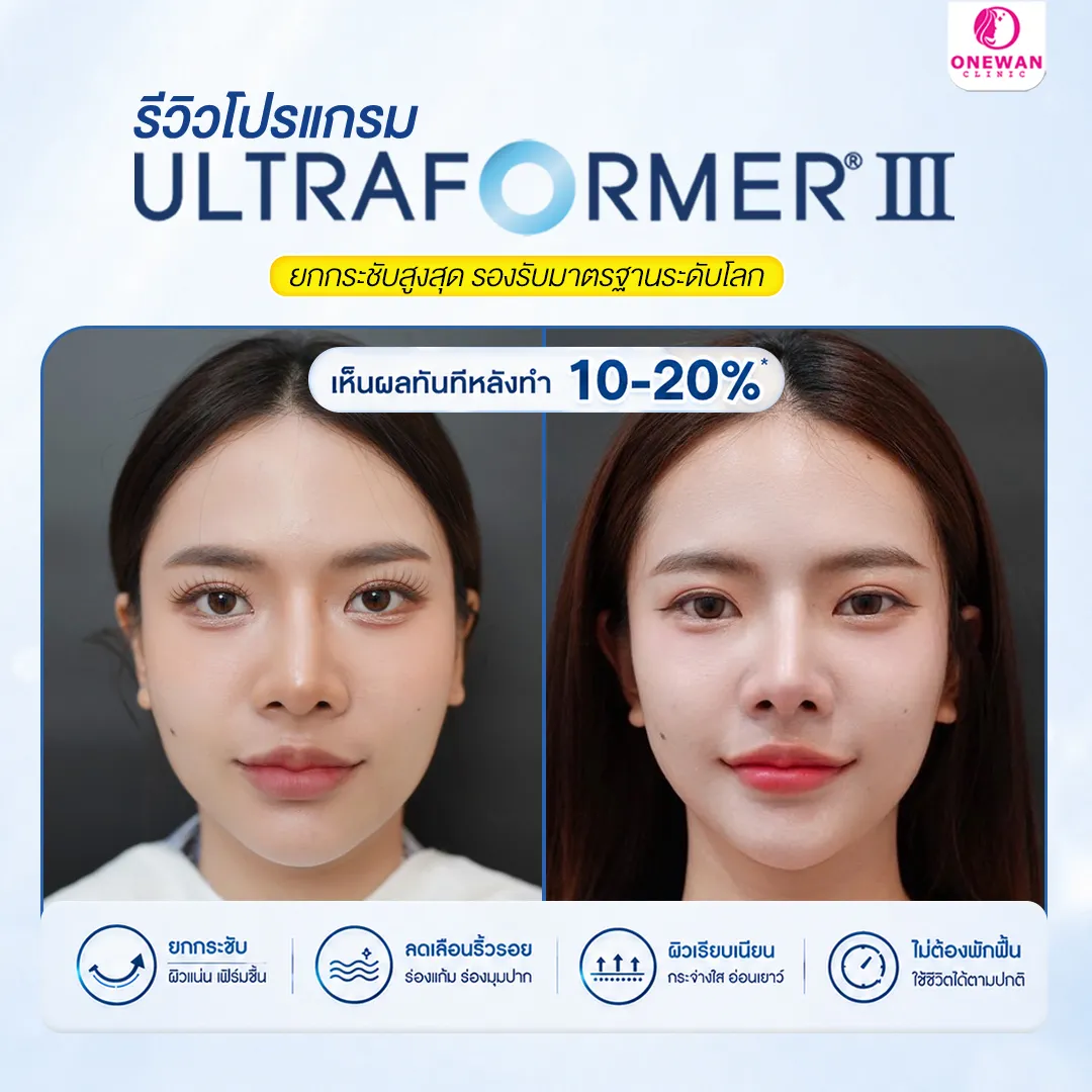 Review 3 Ultraformer III