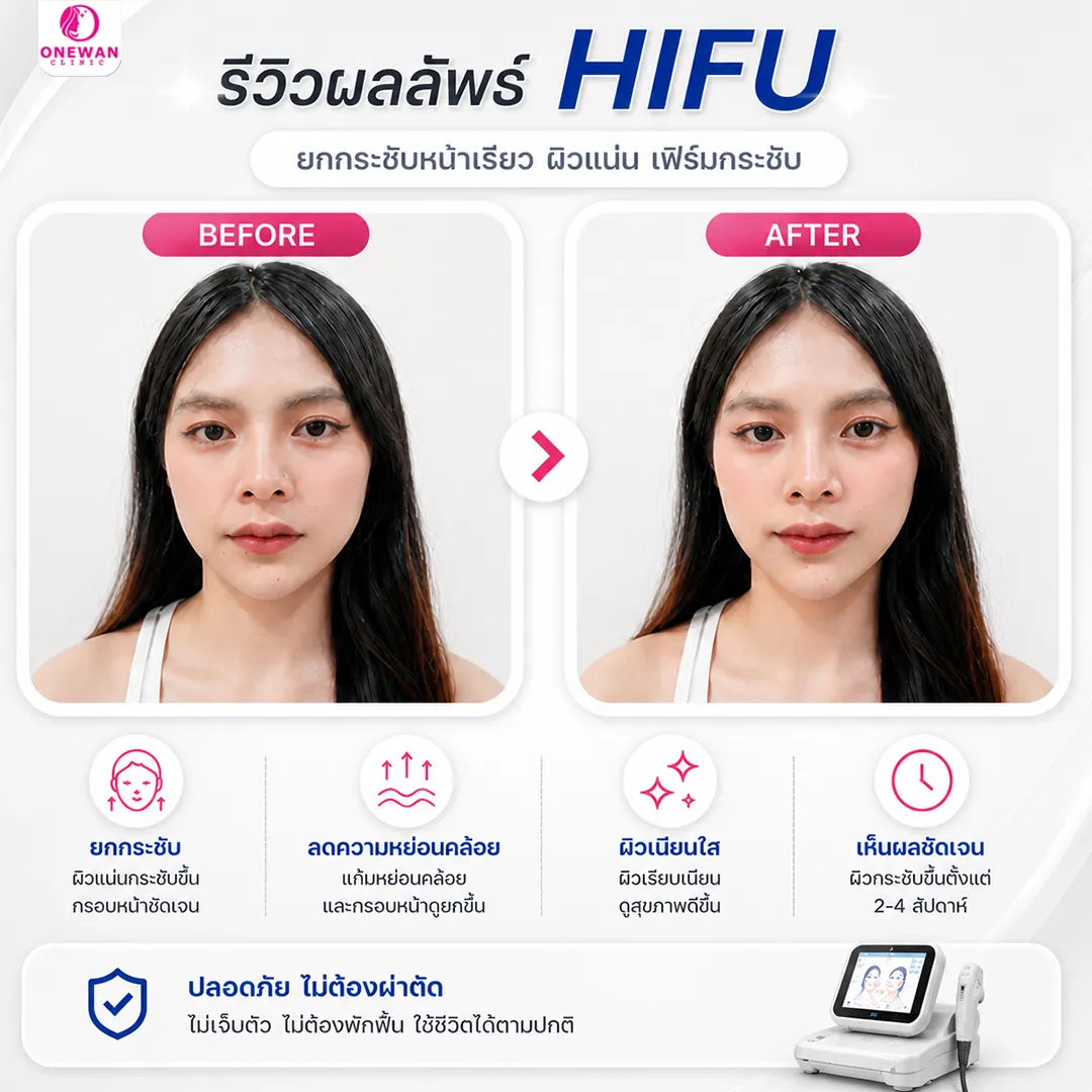 Review Hifu 1