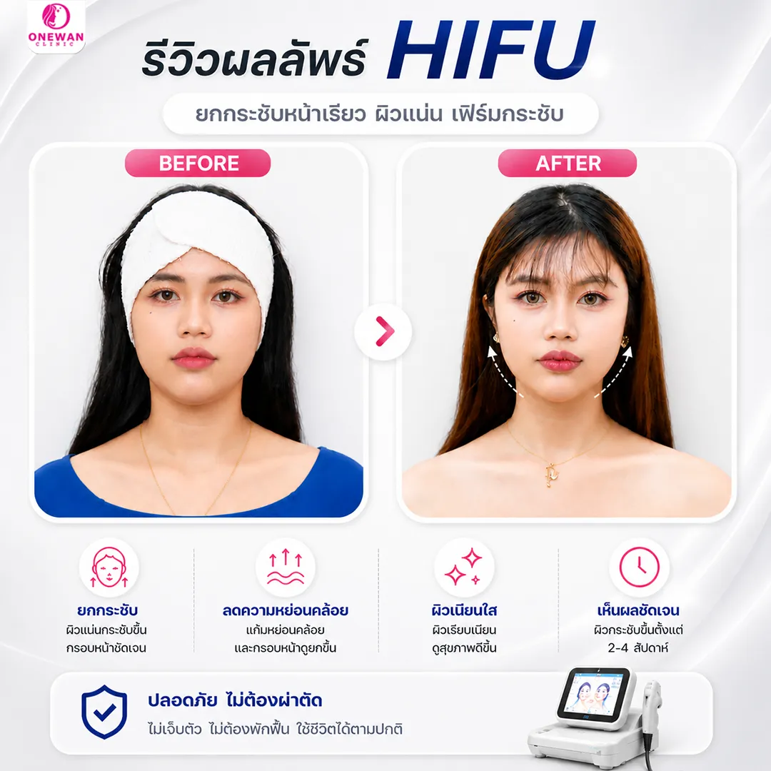 Review Hifu 2