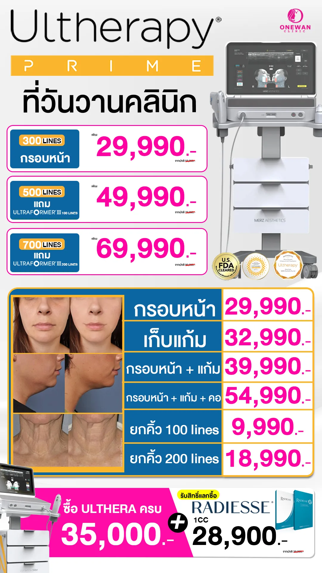 ราคา Ulthera Prime บุรีรัมย์