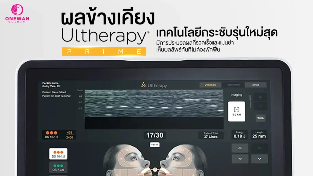 ผลข้างเคียง Ulthera Prime