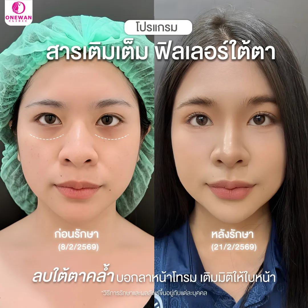 ก่อนหลังฉีดฟิลเลอร์ใต้ตา รีวิว