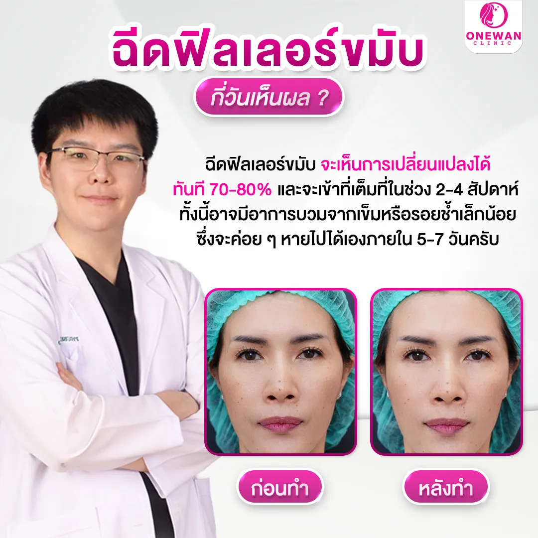 ฉีดฟิลเลอร์ขมับ กี่วันเห็นผล