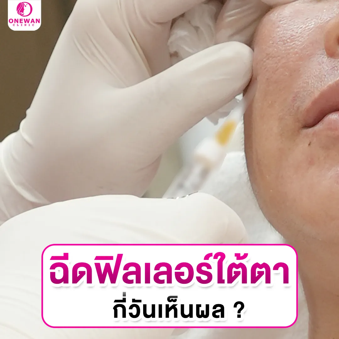 ฉีดฟิลเลอร์ใต้ตากี่วันเห็นผล