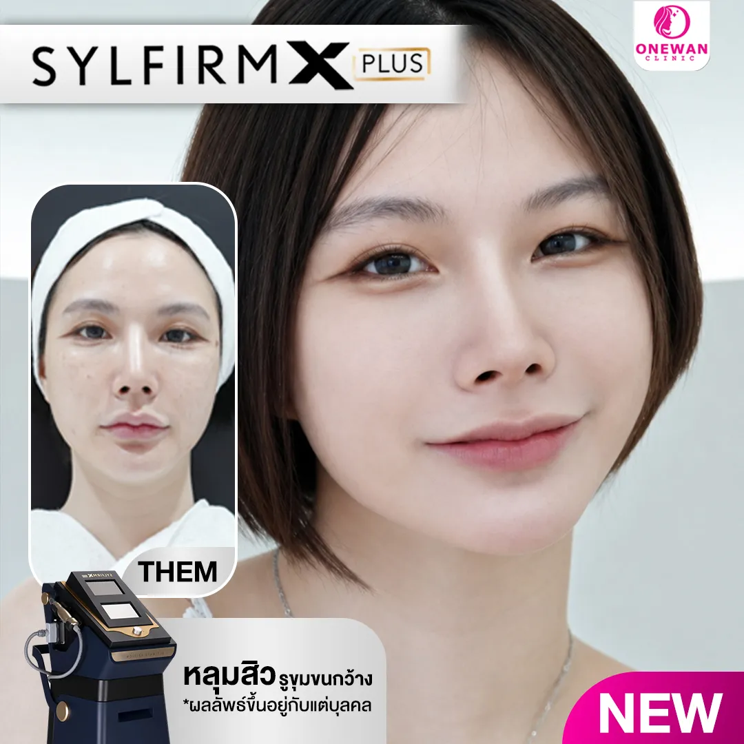รีวิวหลังทำ Sylfirm X Plus ที่ วันวาน คลินิกความงามบุรีรัมย์ 2