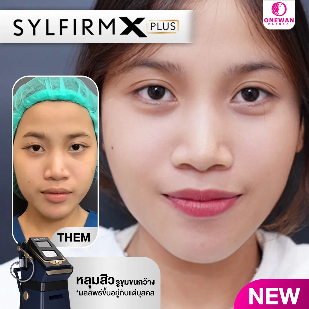 รีวิวหลังทำ Sylfirm X Plus ที่ วันวาน คลินิกความงามบุรีรัมย์