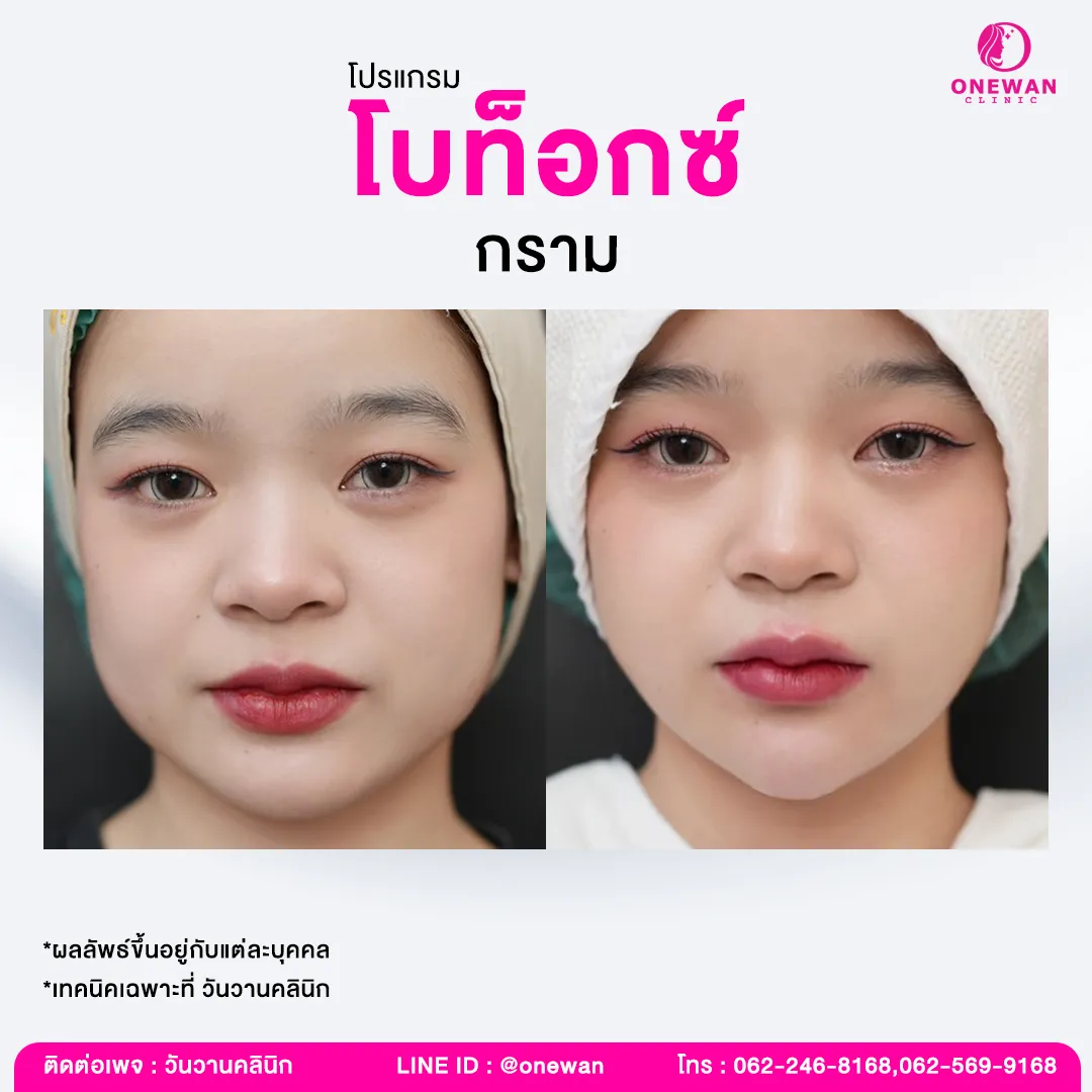 รีวิวโบท็อกกราม 2