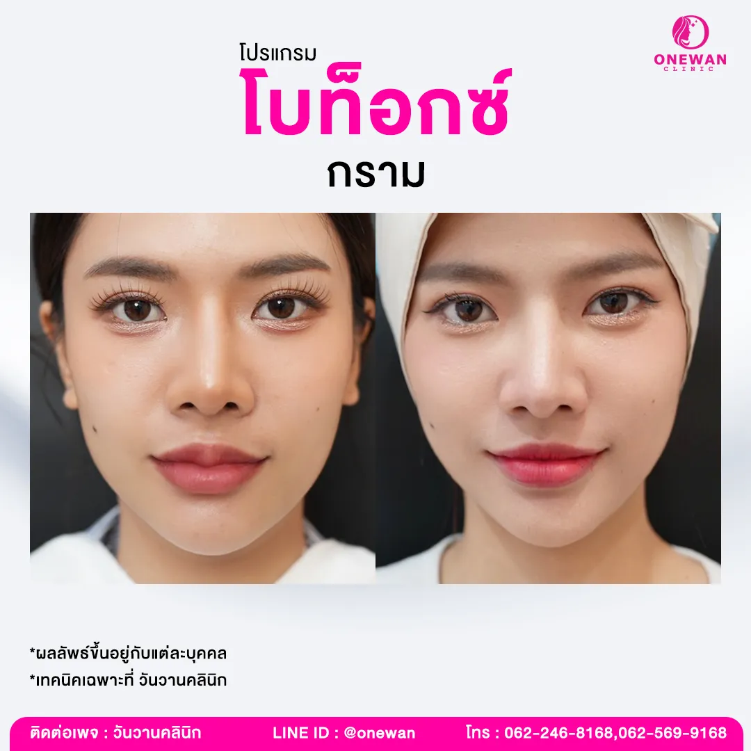 รีวิวโบท็อกกราม 3