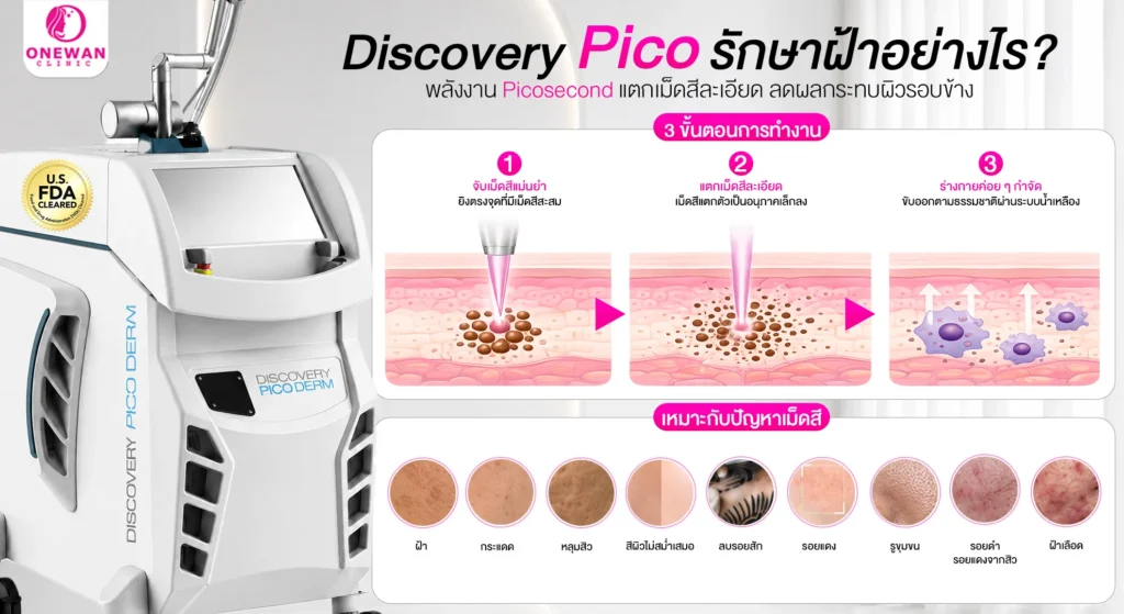 Discovery Pico รักษาฝ้าอย่างไร