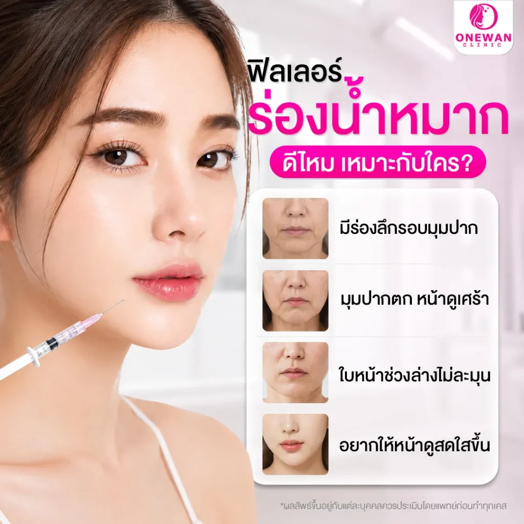 ฟิลเลอร์ร่องน้ำหมากดีไหม เหมาะกับใคร