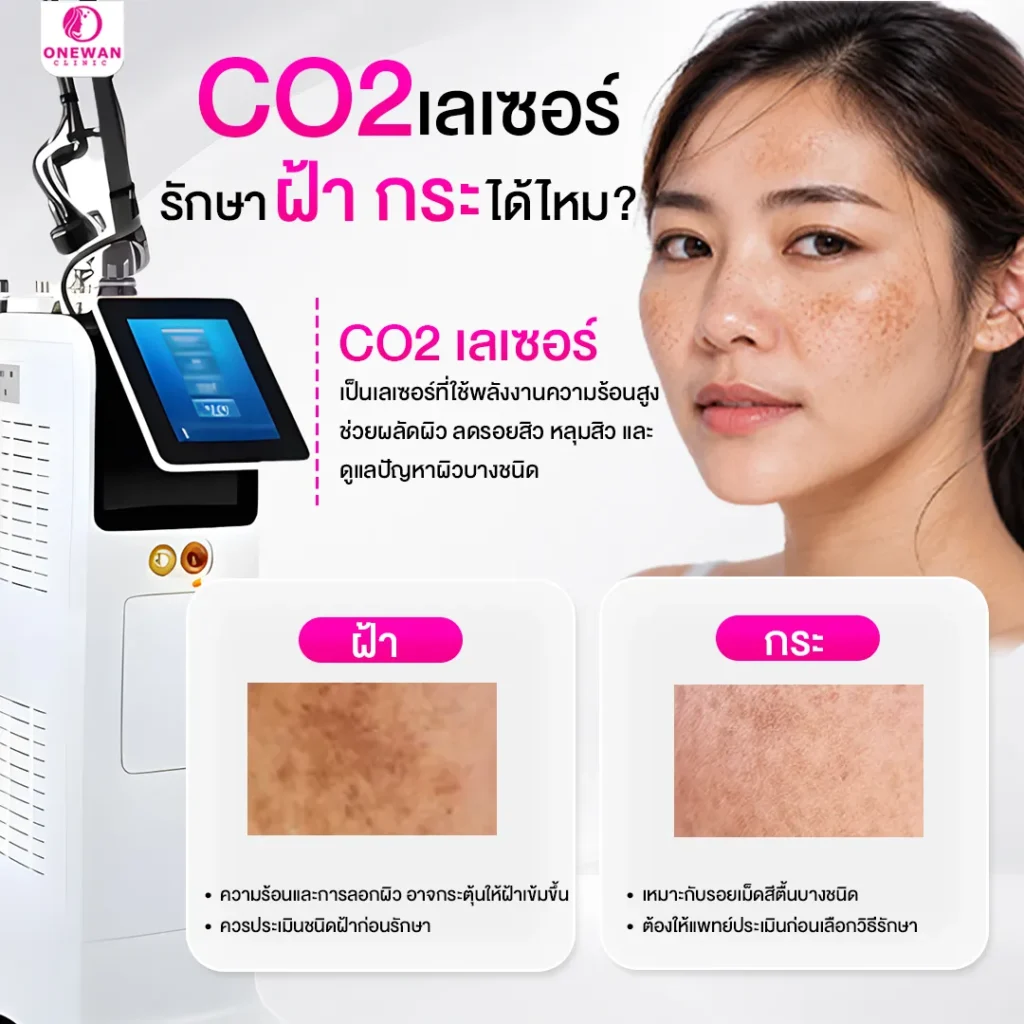 CO2 เลเซอร์รักษาฝ้ากระได้ไหม