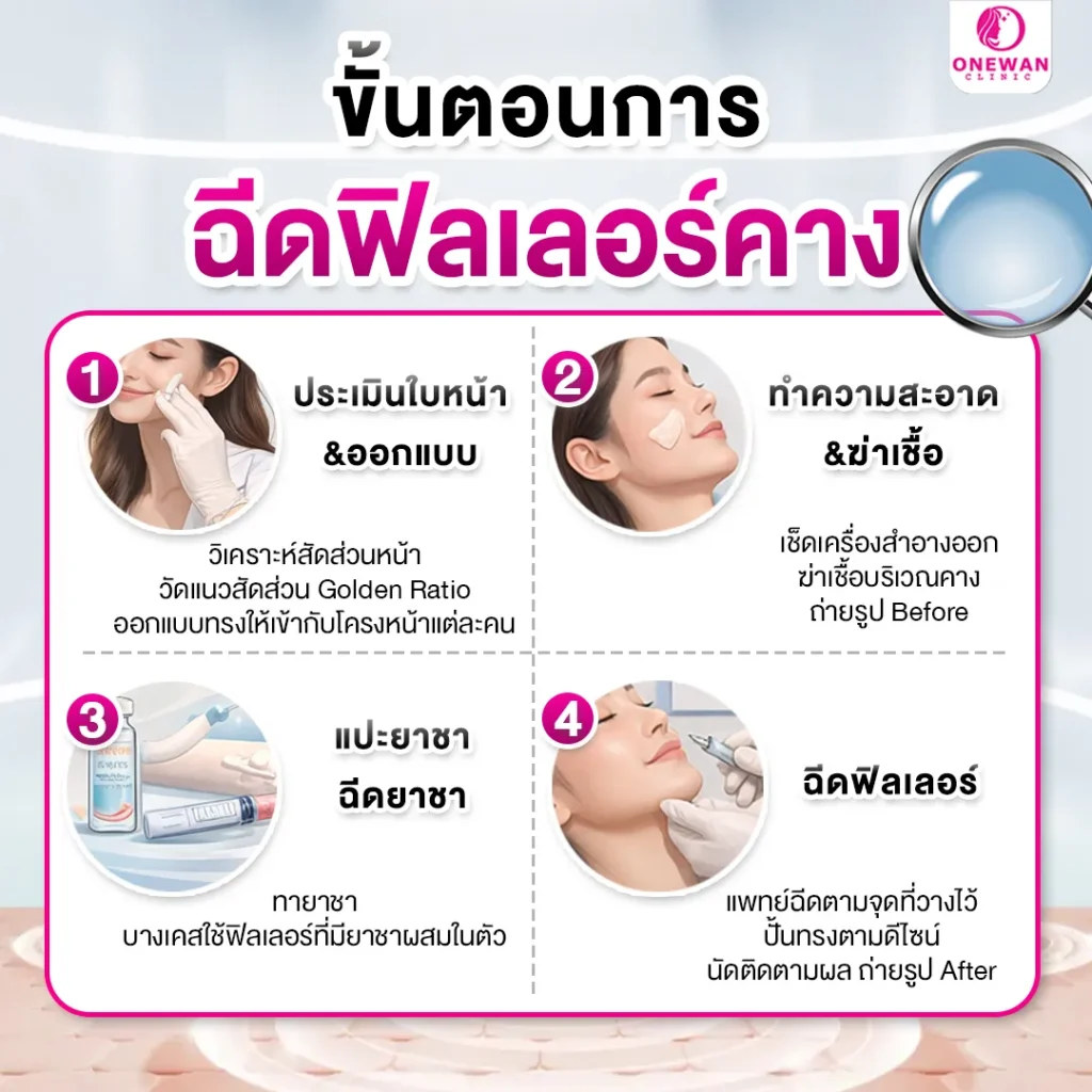 ขั้นตอนการฉีดฟิลเลอร์คาง