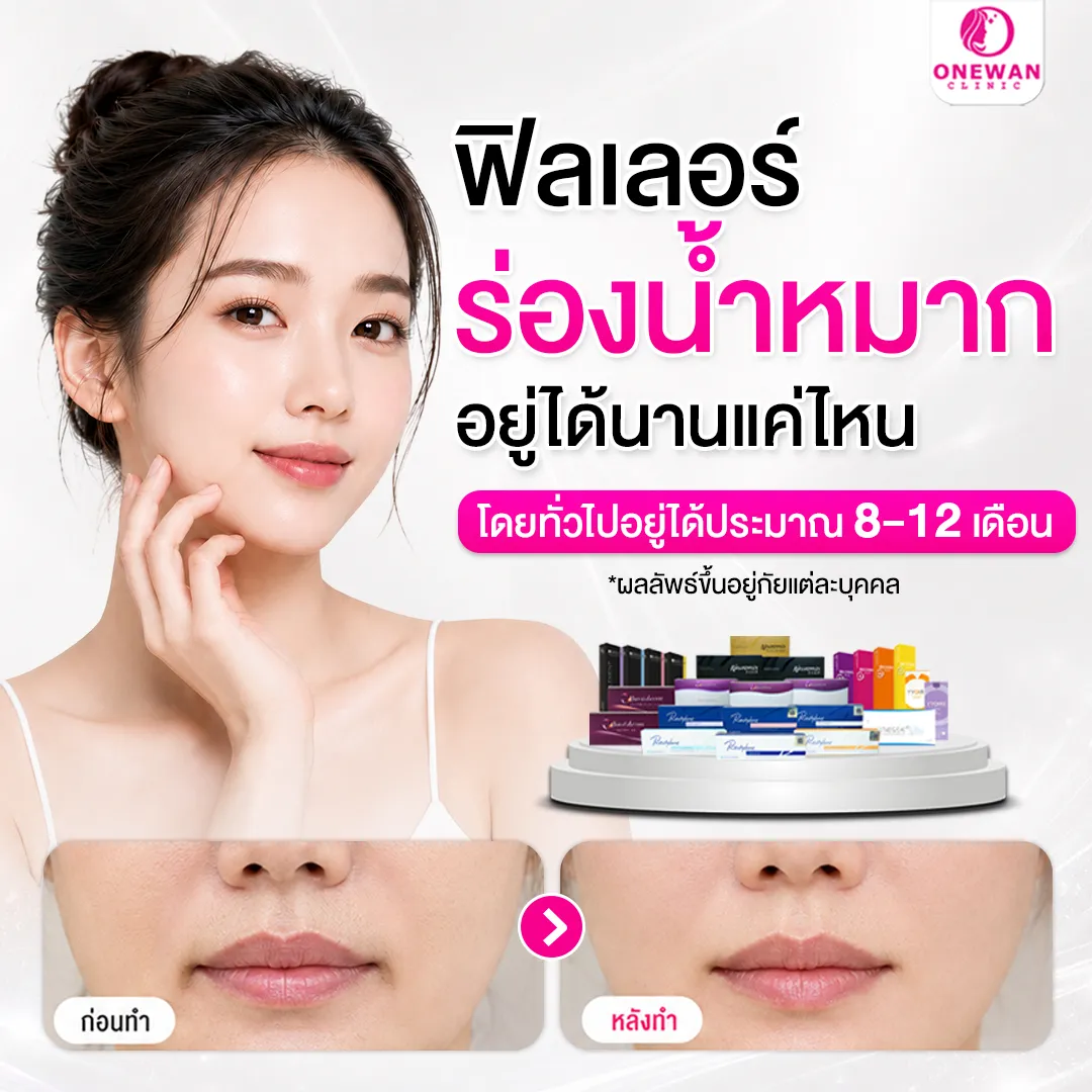ฟิลเลอร์ร่องน้ำหมากอยู่ได้นานแค่ไหน
