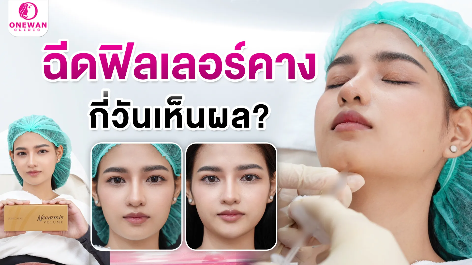 ฉีดฟิลเลอร์คางเห็นผลกี่วัน