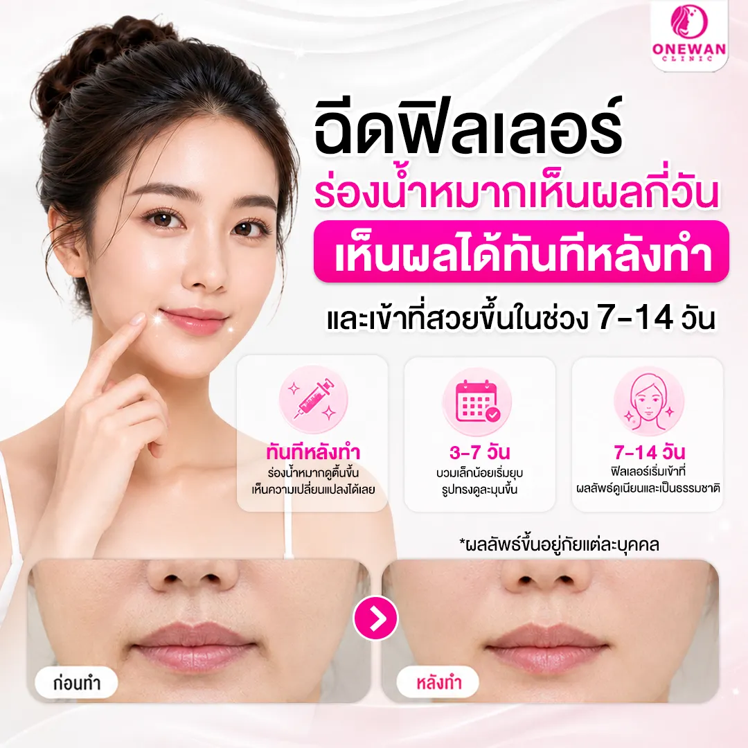ฉีดฟิลเลอร์ร่องน้ำหมากเห็นผลกี่วัน