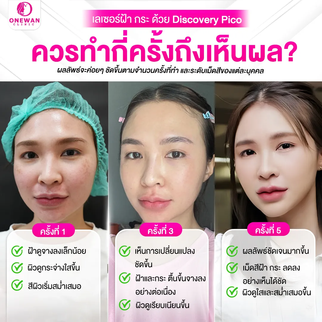 เลเซอร์ฝ้ากระด้วย Discovery Pico ควรทำกี่ครั้งถึงเห็นผล