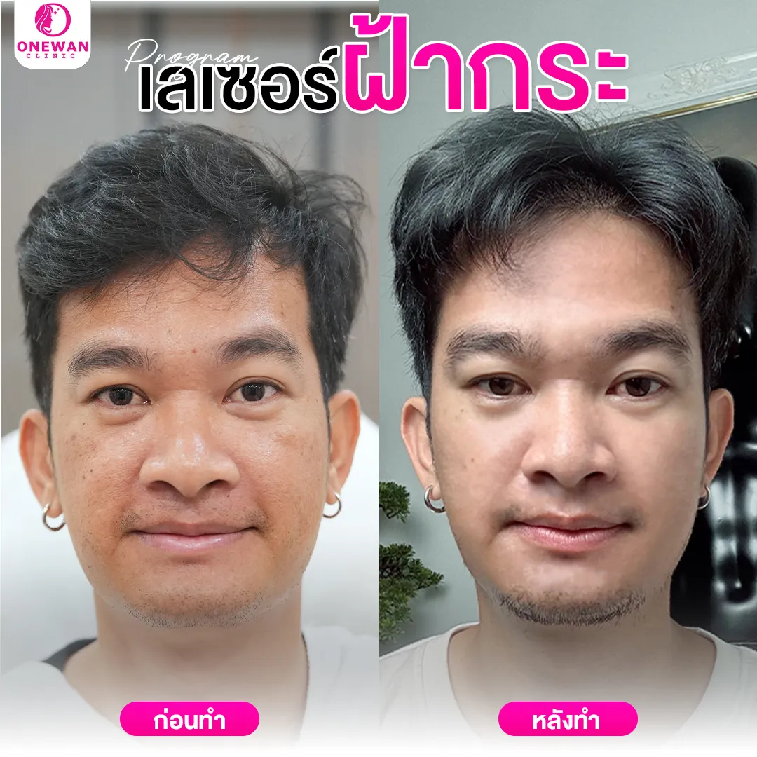 เลเซอร์ฝ้ากระ ก่อนทำ-หลังทำ 1