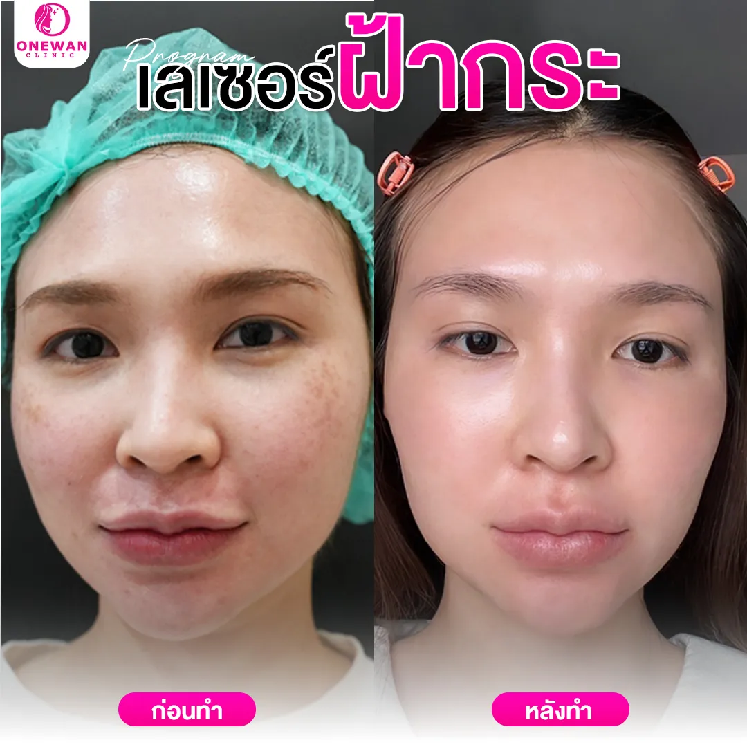 เลเซอร์ฝ้ากระ ก่อนทำ-หลังทำ 2