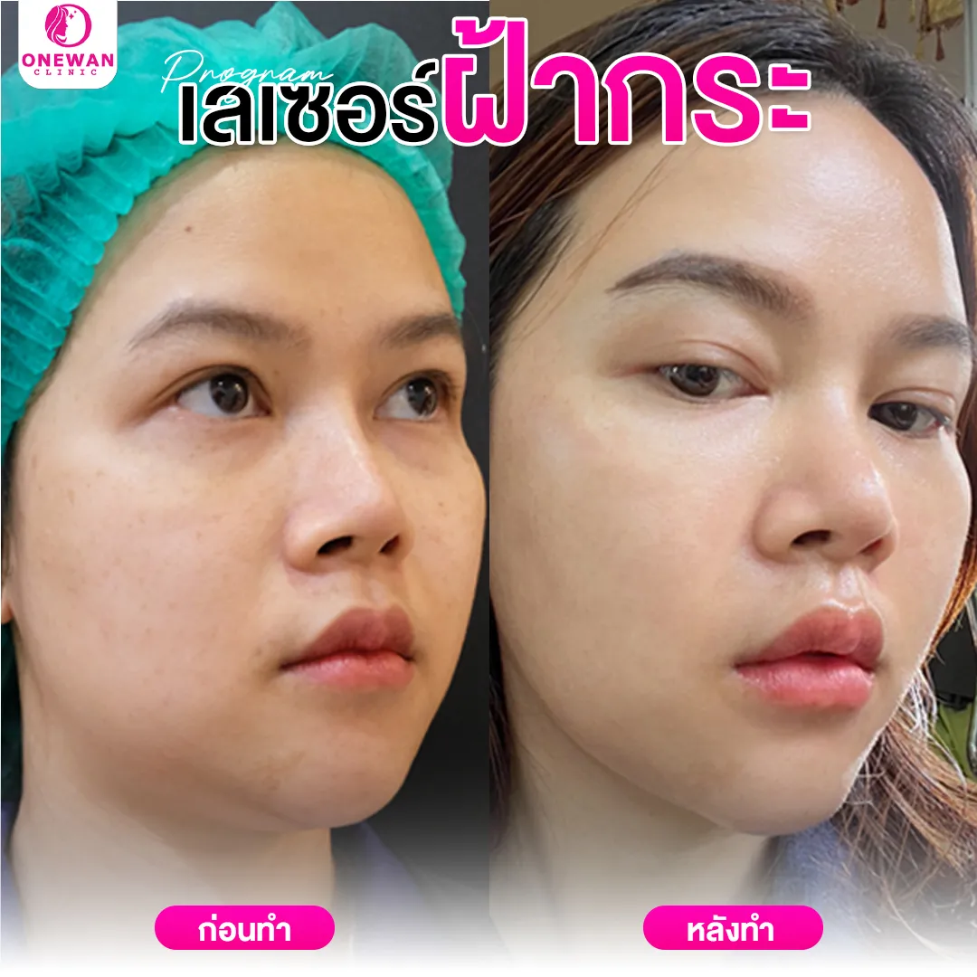 เลเซอร์ฝ้ากระ ก่อนทำ-หลังทำ 4