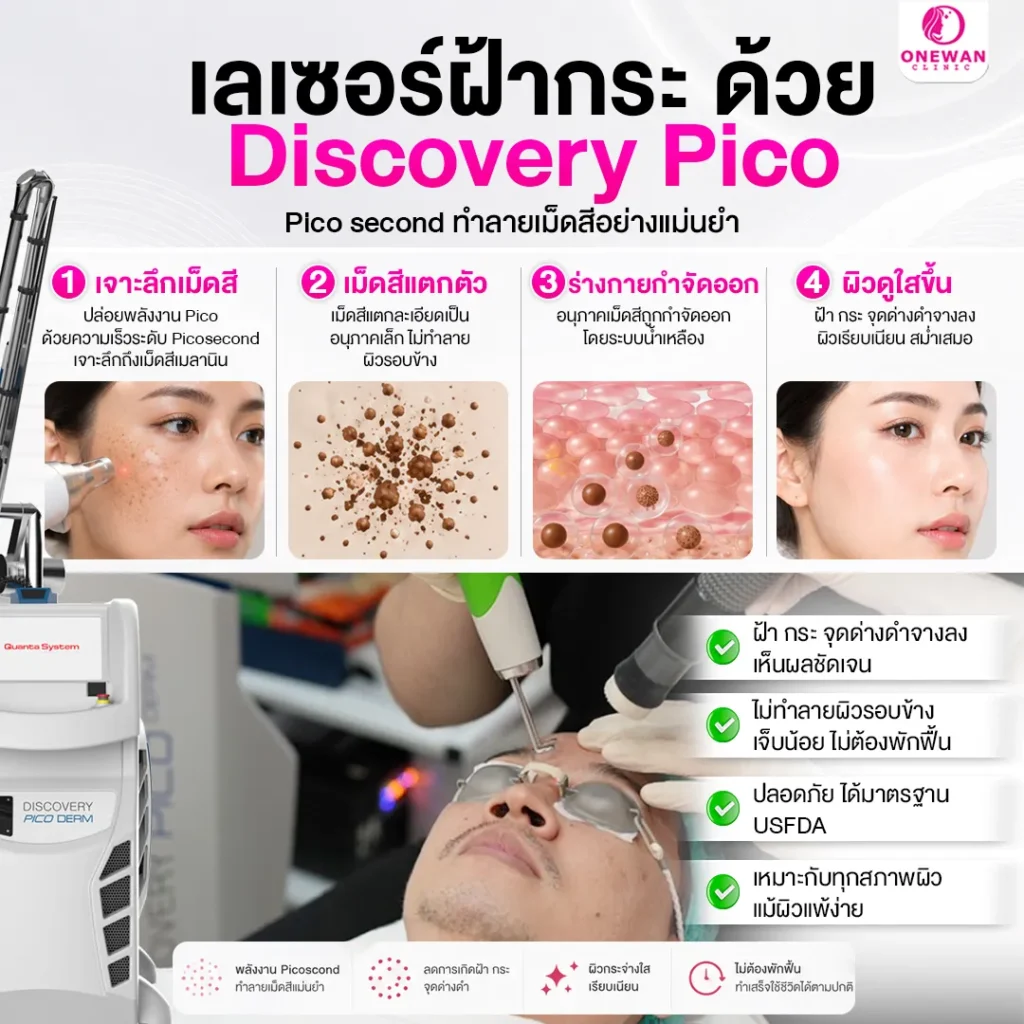 เลเซอร์ฝ้ากระด้วย Discovery Pico