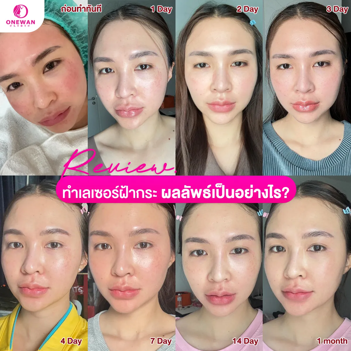 รีวิวทำเลซอร์ฝ้ากระ 1