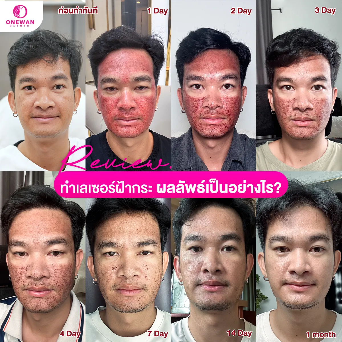 รีวิวทำเลซอร์ฝ้ากระ 2