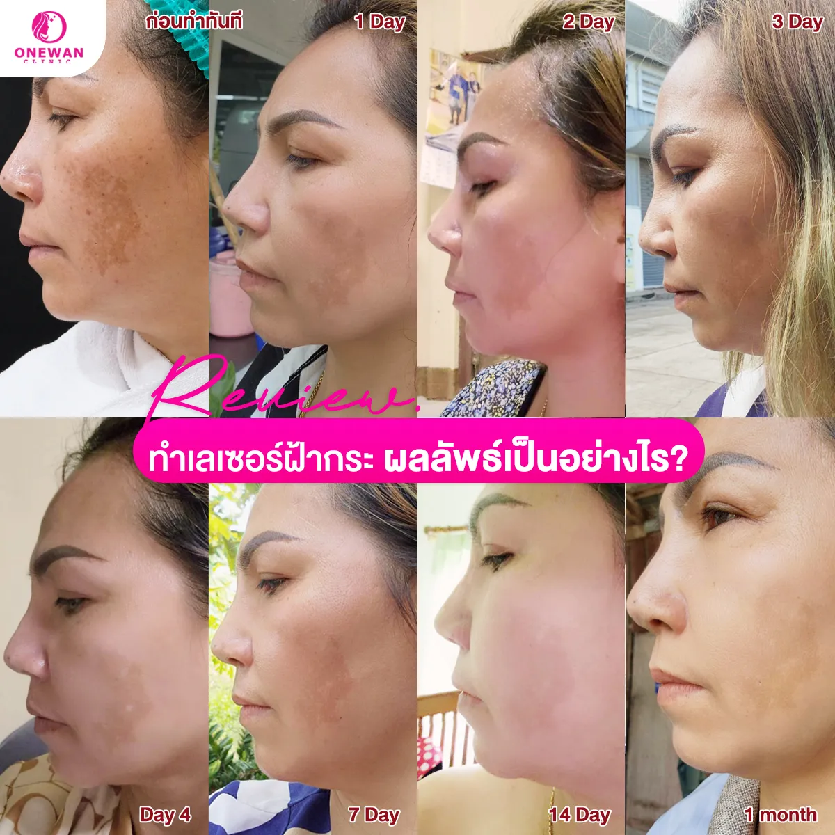 รีวิวทำเลซอร์ฝ้ากระ 3