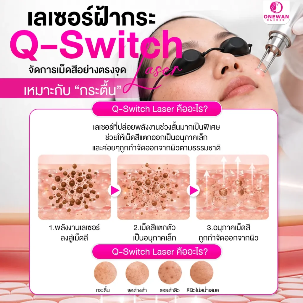 เลเซอร์ฝ้ากระด้วย Q-Switch Laser