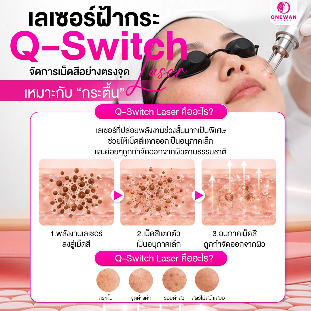 เลเซอร์ฝ้ากระด้วย Q-Switch Laser