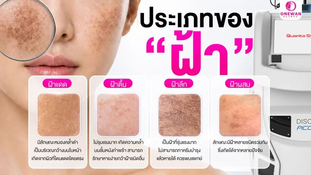 รู้จักประเภทของฝ้า