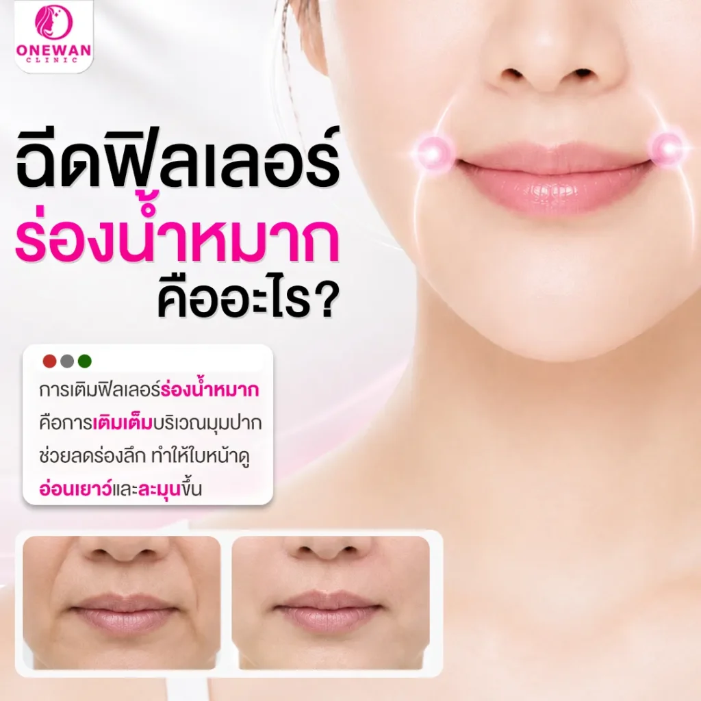 ฉีดฟิลเลอร์ร่องน้ำหมาก คืออะไร