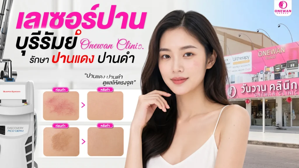 เลเซอร์ปาน บุรีรัมย์