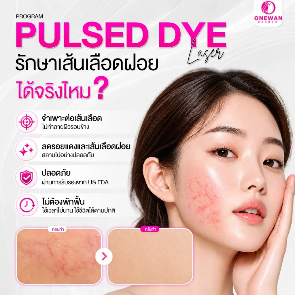 Pulse Dye Laser รักษาเส้นเลือดฝอยได้จริงไหม