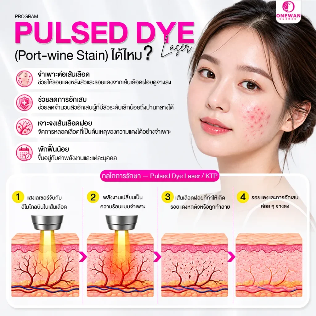 Pulse Dye Laser ลดรอยแดงจากสิว สิวอักเสบได้ไหม