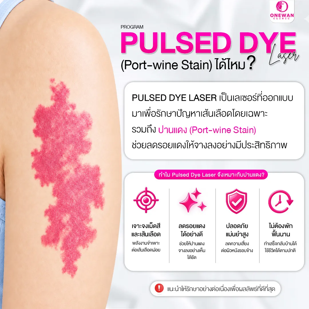 Pulse Dye Laser รักษาปานแดง (Port-wine Stain) ได้ไหม
