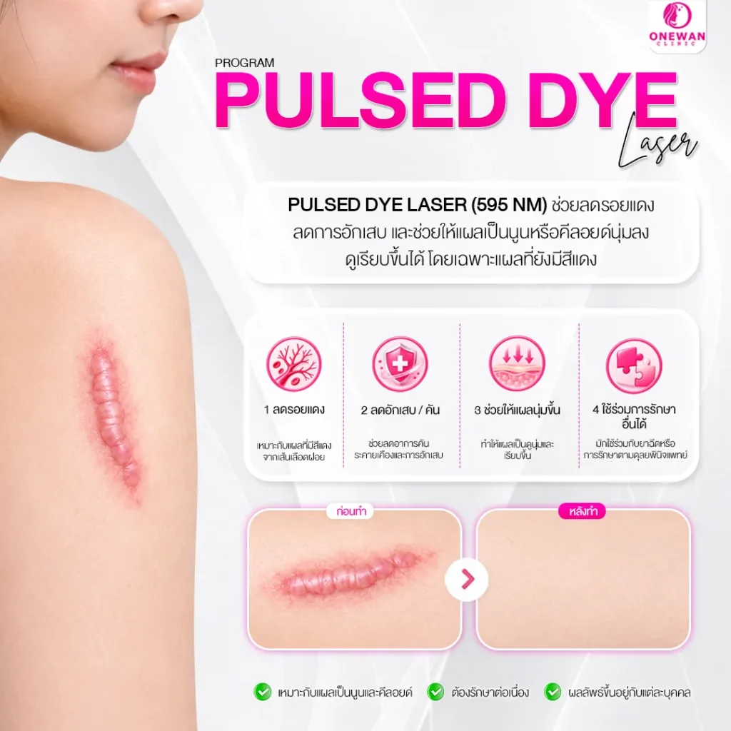 Pulse Dye Laser รักษาแผลเป็นนูน คีลอยด์ได้ไหม