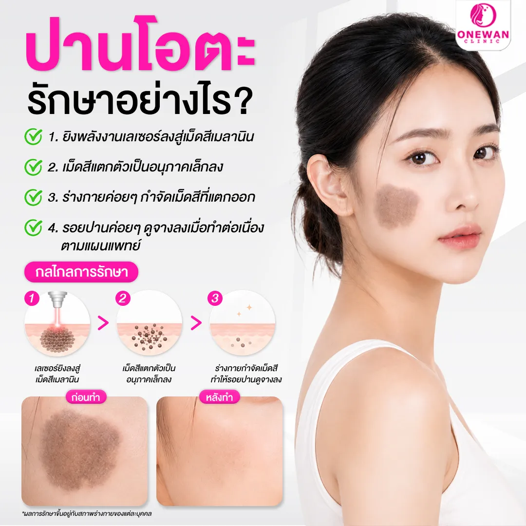 เลเซอร์ปานดำ รักษาอย่างไร