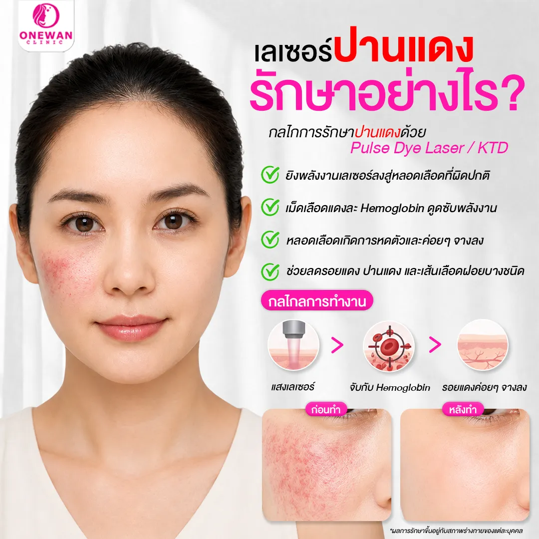 เลเซอร์ปานแดง รักษาอย่างไร