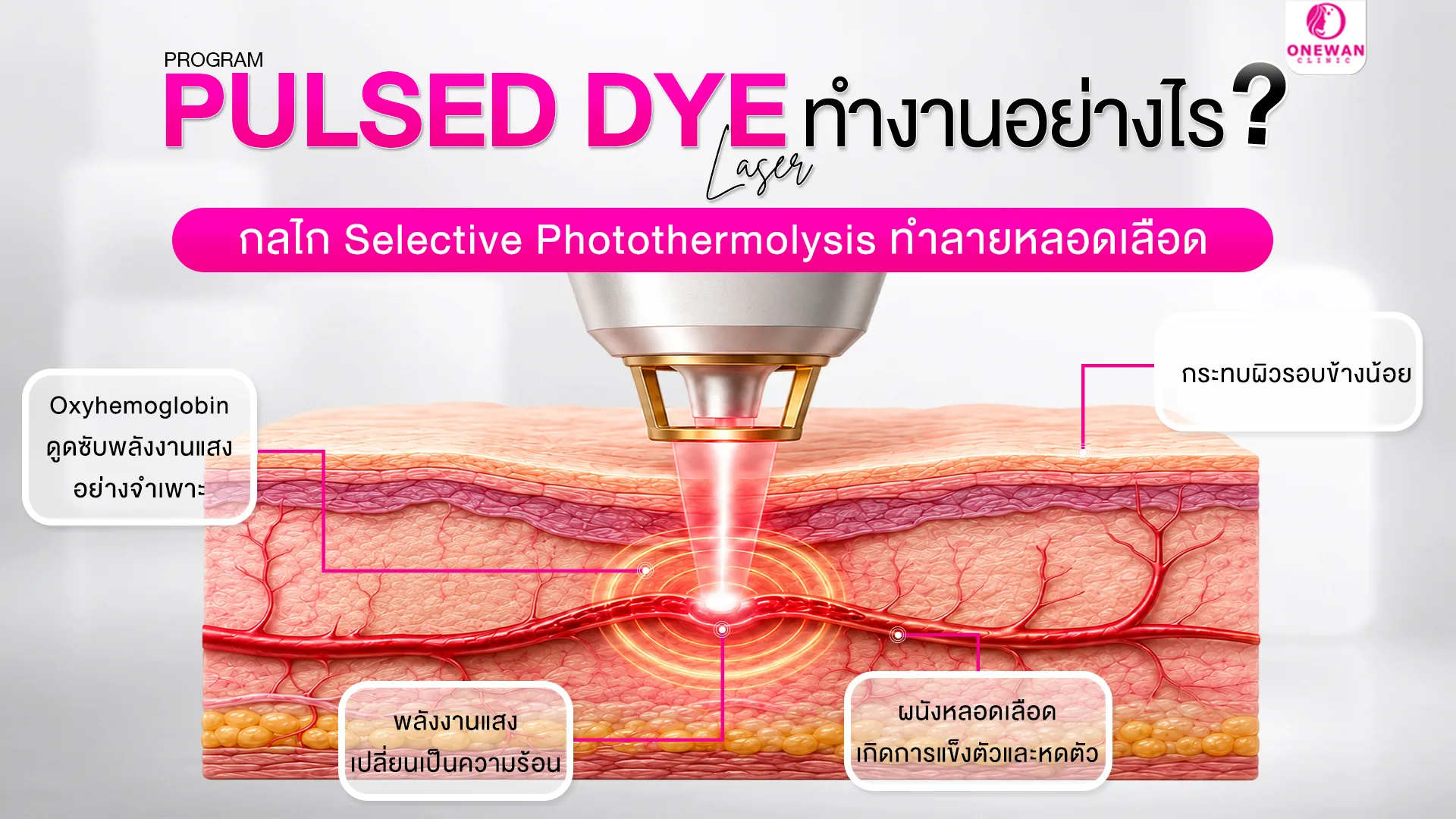 Pulse Dye Laser ทำงานอย่างไร